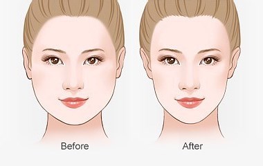 蜕变项目6s光塑焕肤