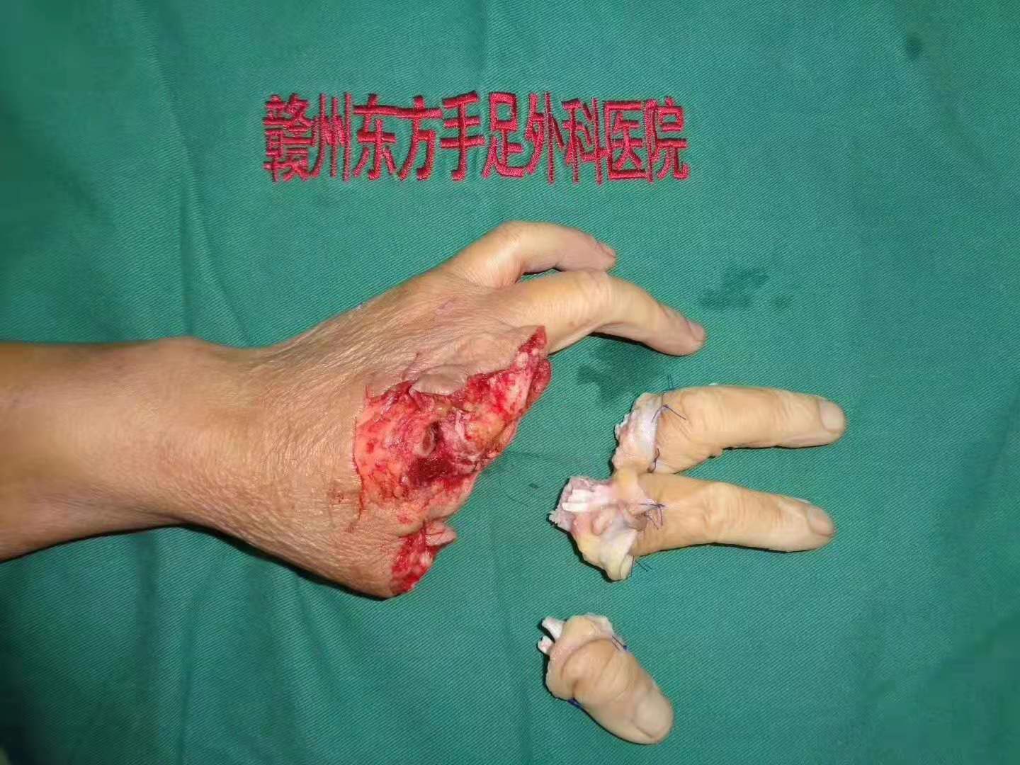 断指再植病例