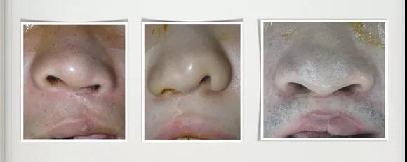 台湾长庚医院修复唇颚裂患者