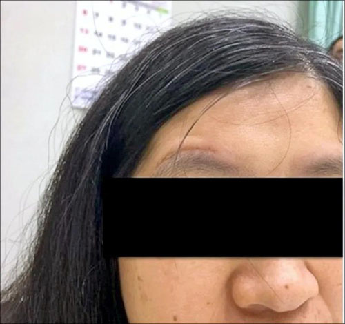 微创钥匙孔开颅术,开脑免剃光头 微创钥匙孔开颅术,开脑免剃光头