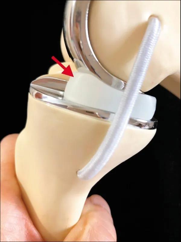 台湾长庚医院半膝关节置换手术 台湾长庚医院半膝关节置换手术