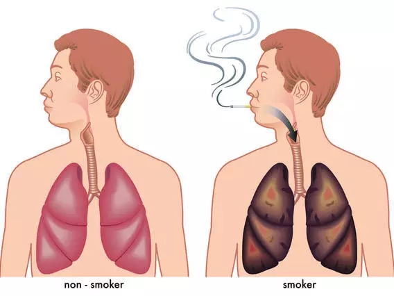 常抽烟的人的肺部和不抽烟的人的肺部对比图