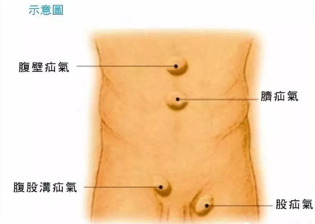 常见的疝有腹股沟疝,股疝,脐疝,切口疝,腹白线疝,造口旁疝等