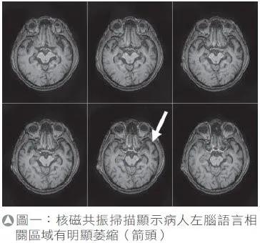 【台湾长庚医院】年轻型失智症的早期诊疗