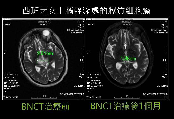 台湾硼中子捕获治癌