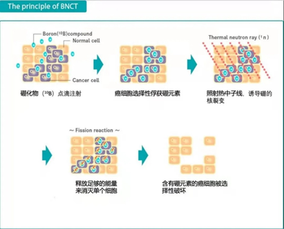 硼中子俘获疗法适合头颈癌