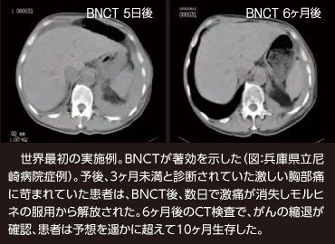 硼中子俘获治疗癌症效果怎么样，有没有后遗症