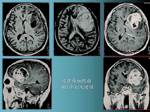 利用硼中子捕获方式台湾首例治疗复发性颅内恶性胶质细胞瘤经验