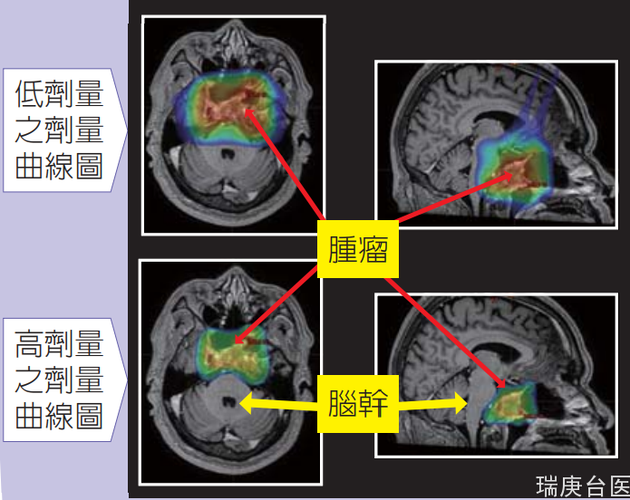 臺灣長庚醫院案例 | 腦瘤的強度調控質子治療