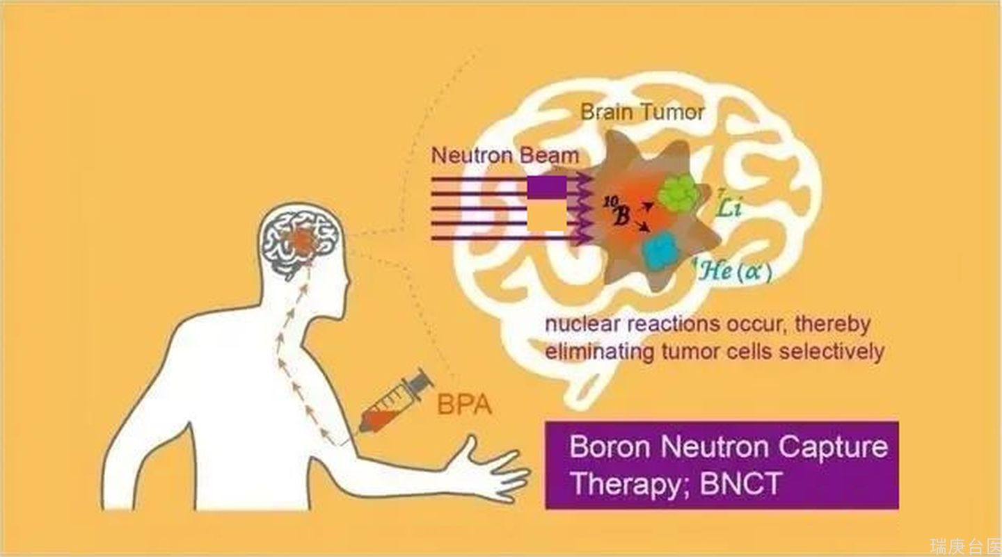 BNCT案例 | 選擇臺灣腦瘤硼中子俘獲治療