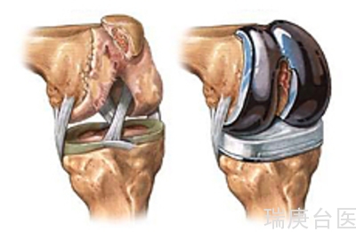 人工关节置换