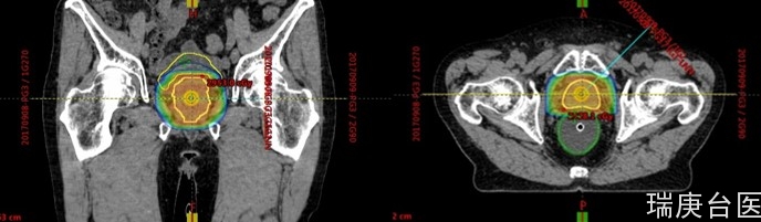 质子治疗 | 采用质子治疗于摄护腺癌可获得良好的疾病控制率，同时降低副作用发生