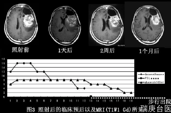 BNCT案例 | 胶质瘤术后复发硼中子捕获治疗