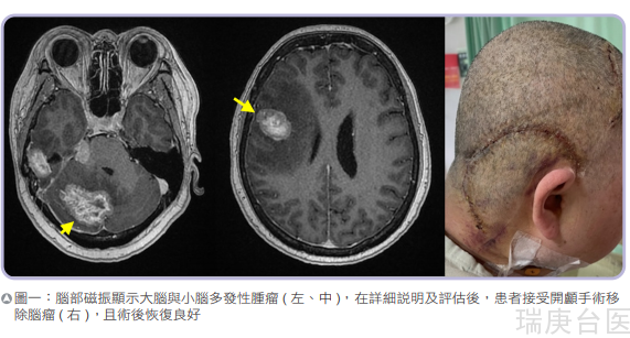 转移性脑瘤手术策略