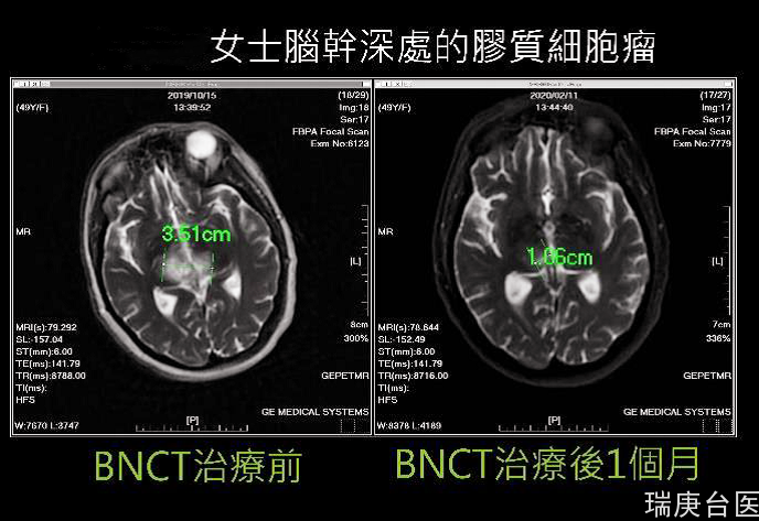 BNCT | 重拾癌患生机 台湾硼中子捕获治癌