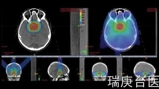 质子治疗中心 | 脑肿瘤质子治疗常见问题答疑