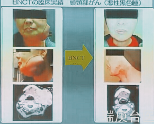 BNCT案例 | 硼中子俘获疗法治疗厉害吗？