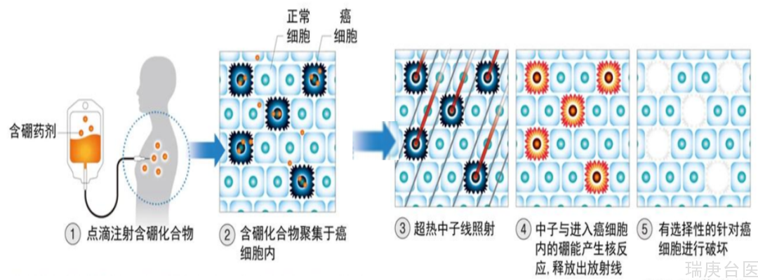 BNCT案例 | 硼中子俘获疗法治疗厉害吗？