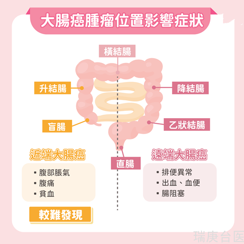 右侧大肠癌VS左侧大肠癌大不同！肿瘤长哪里症状也有差