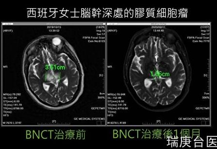 BNCT | 台湾硼中子治疗瞄准肝癌 进入临床实验