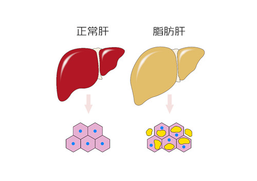 逆转脂肪肝！6种健康好食物 消除堆积脂肪