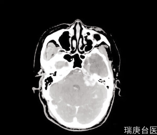 案例分享 | 血管周细胞瘤复发，质子治疗肿瘤较治疗前明显缩小