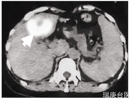 质子治疗 | 肝癌得到完全控制，复查病灶完全消失