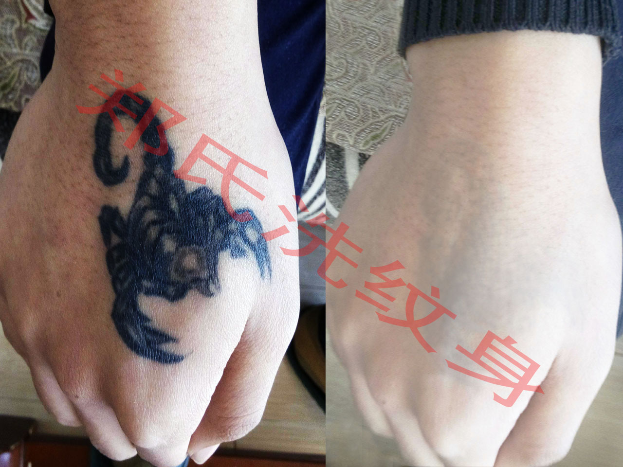 青岛洗纹身
