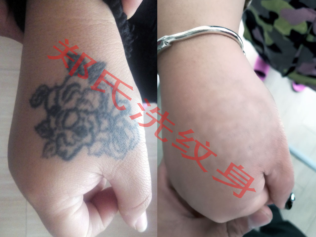 铁岭洗纹身