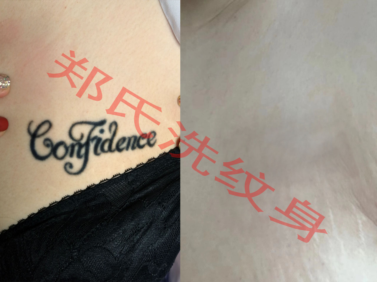 通辽洗纹身