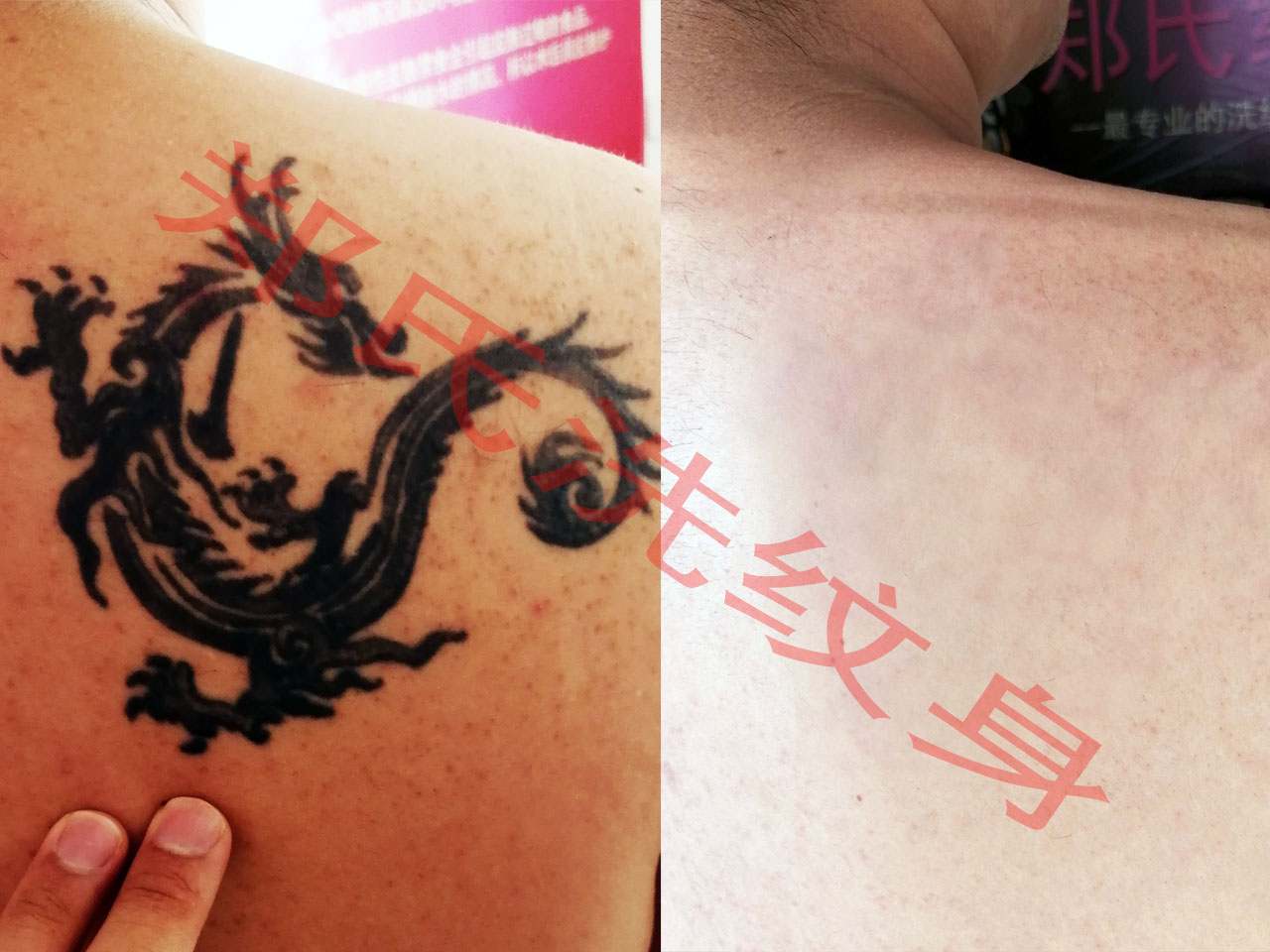 温州洗纹身