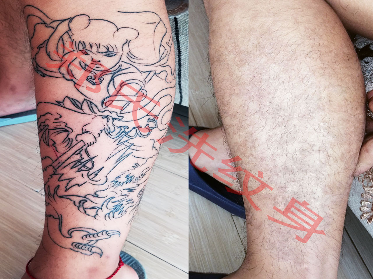 烟台洗纹身
