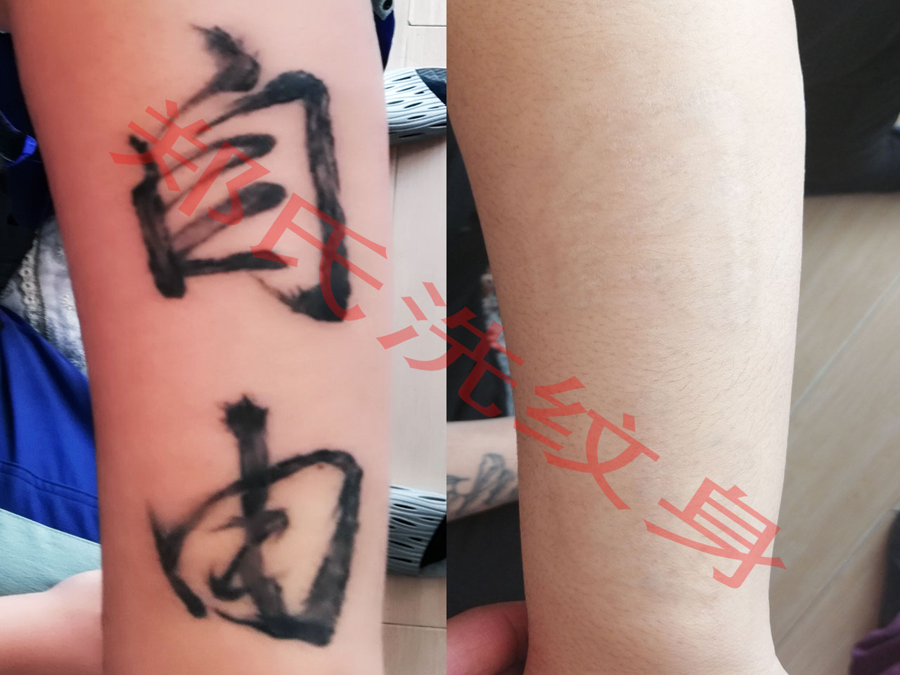 滨州洗纹身