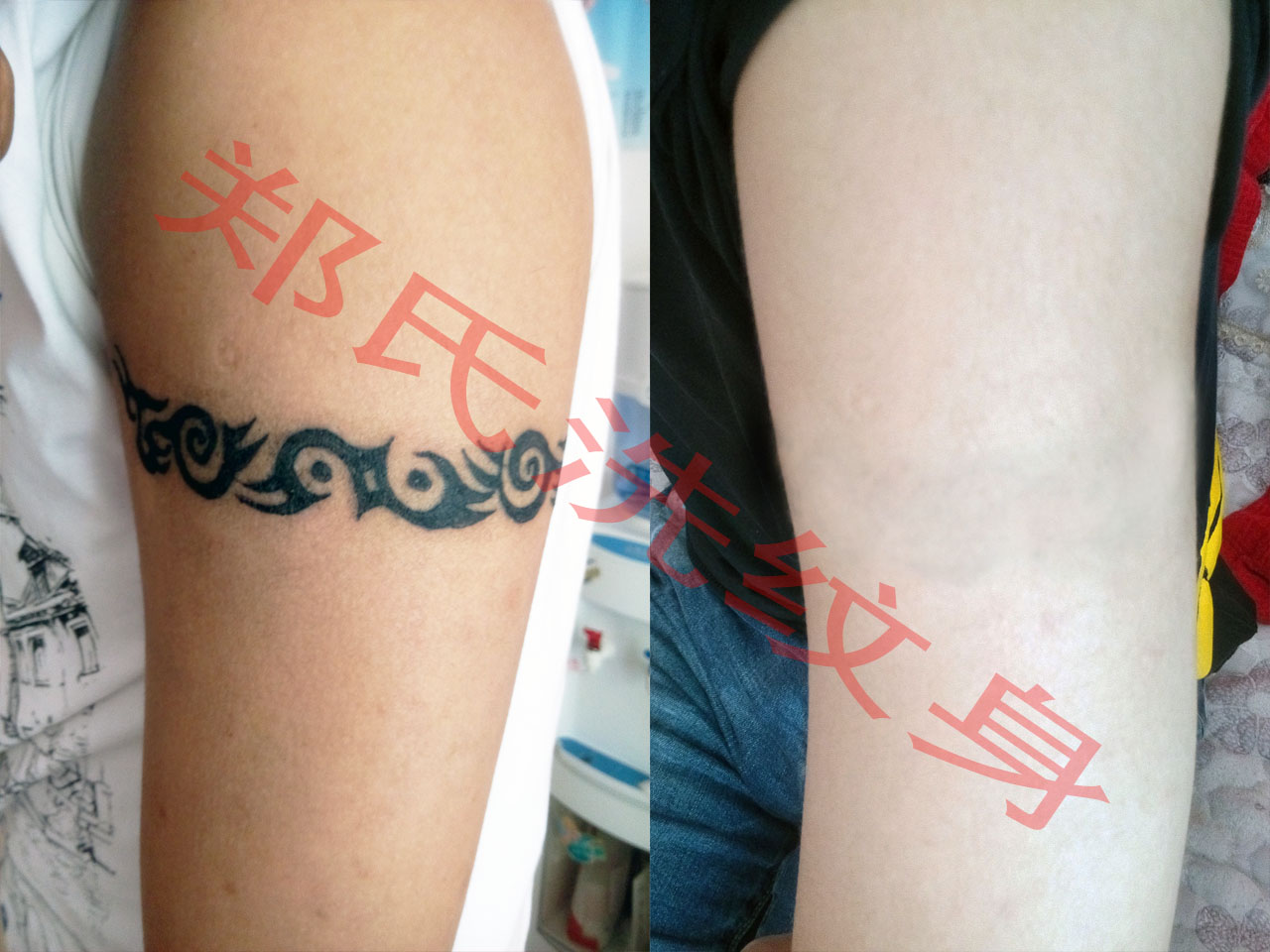 沈阳洗纹身