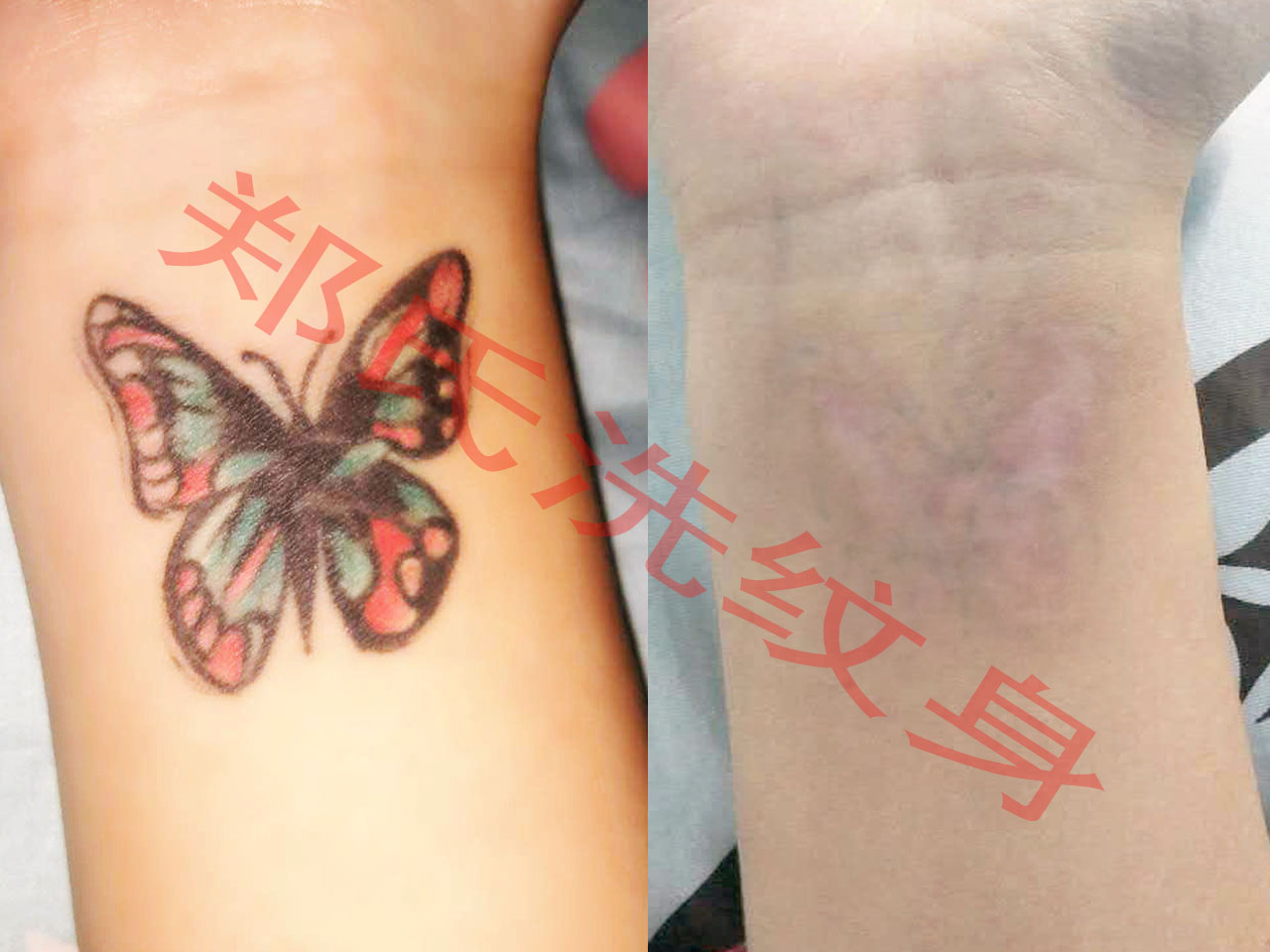 石家庄洗纹身