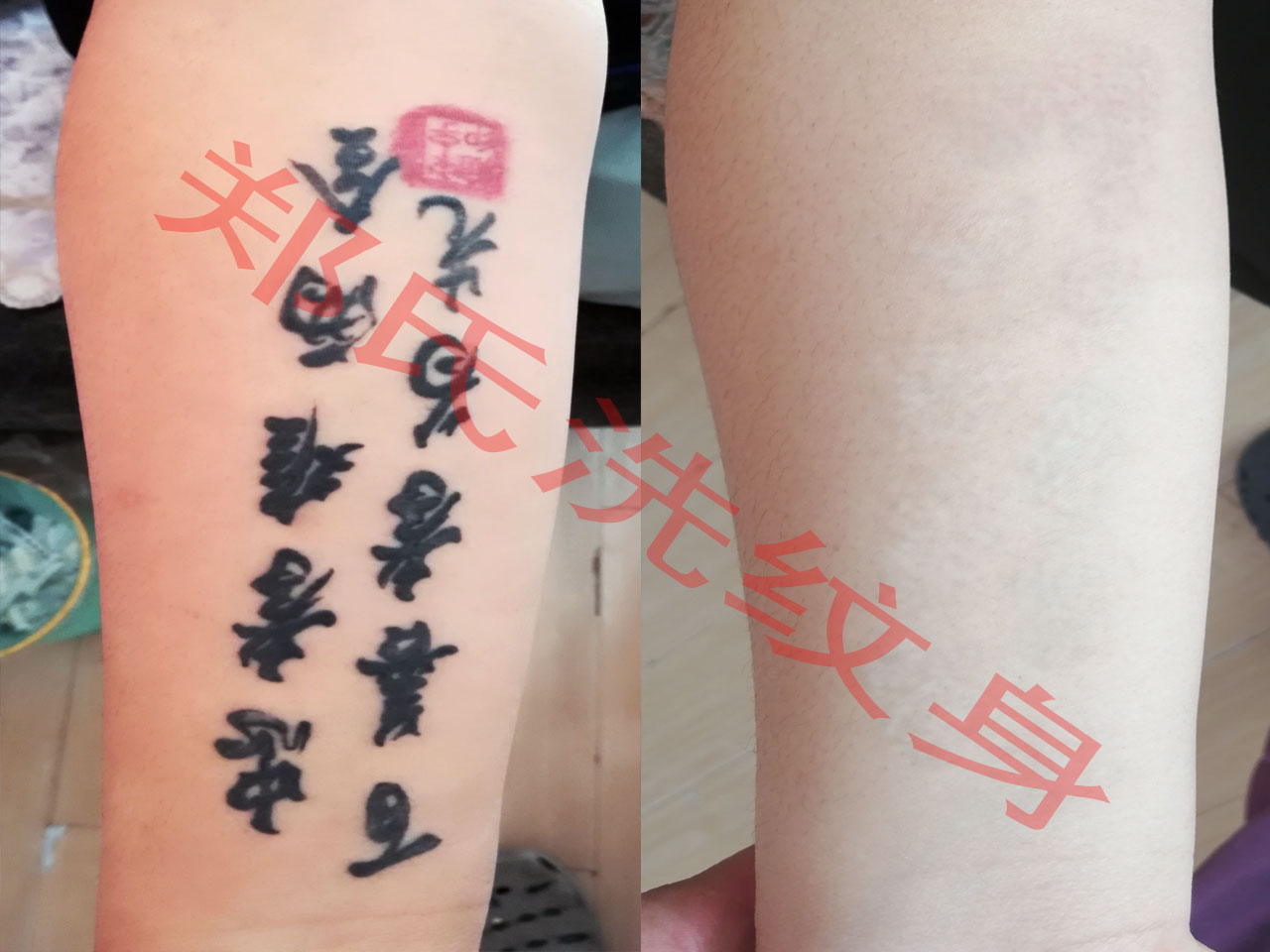 营口洗纹身