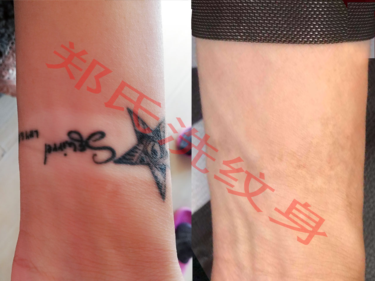 郑州洗纹身