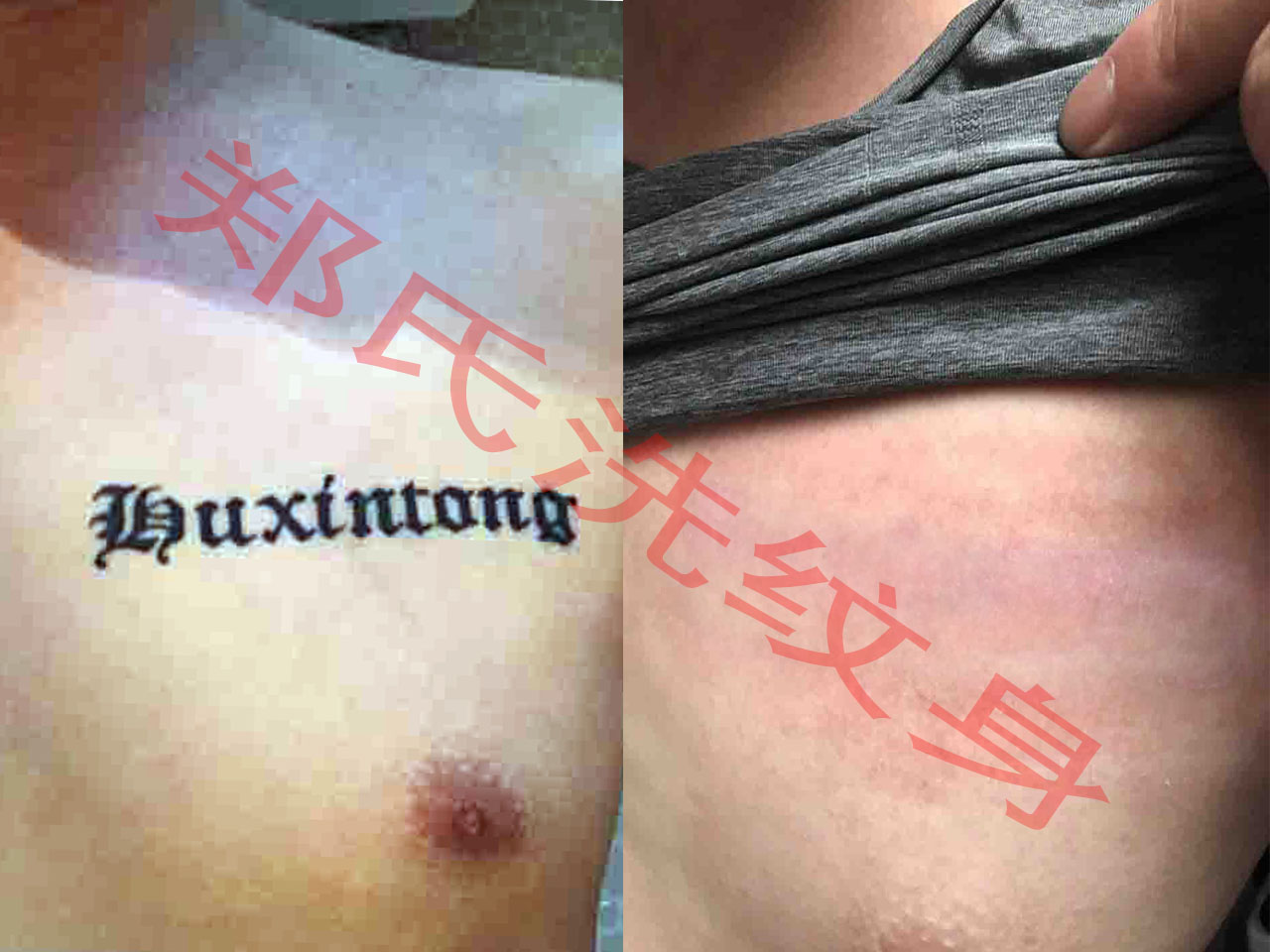 辽阳洗纹身