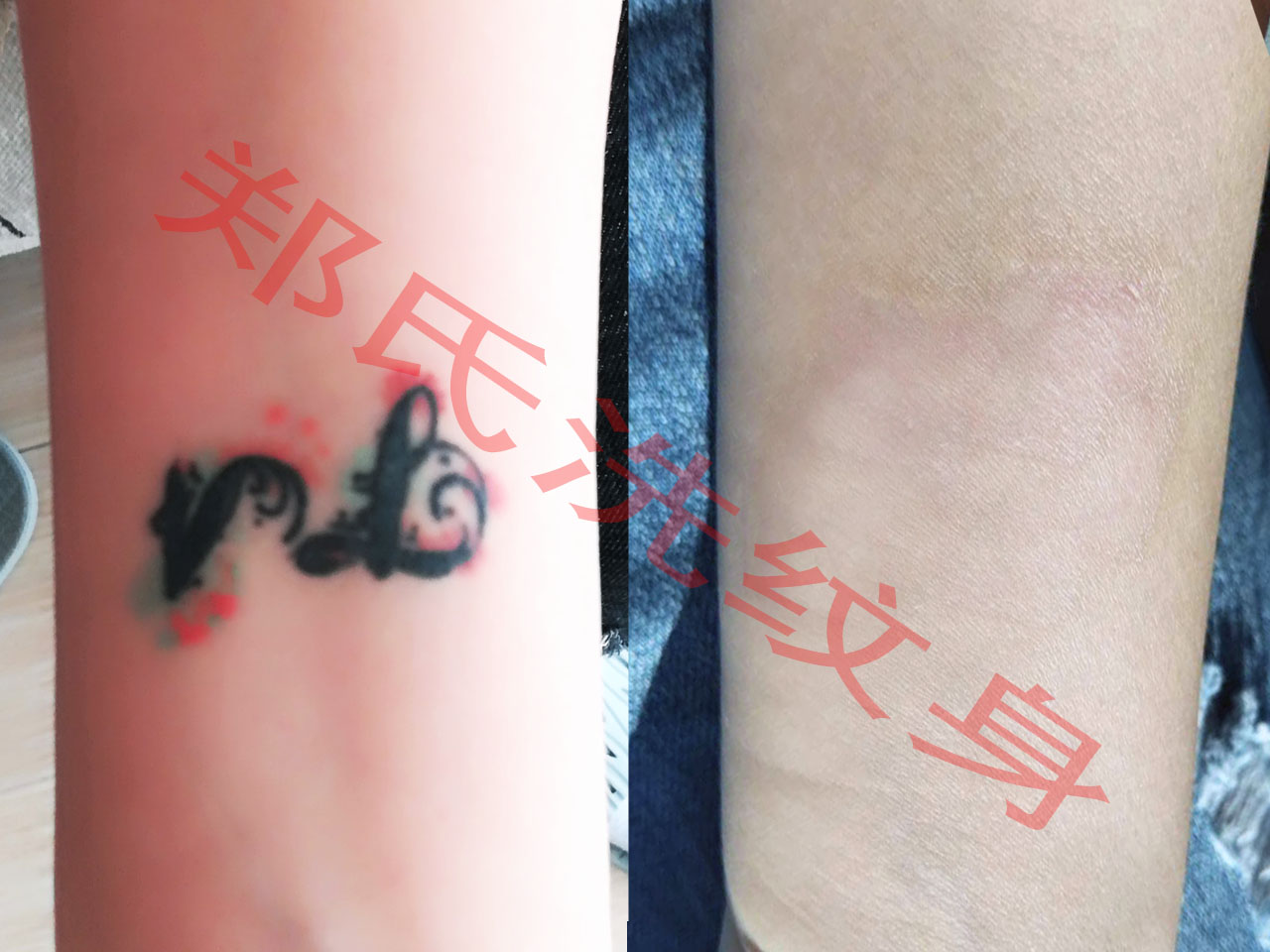 铁岭洗纹身