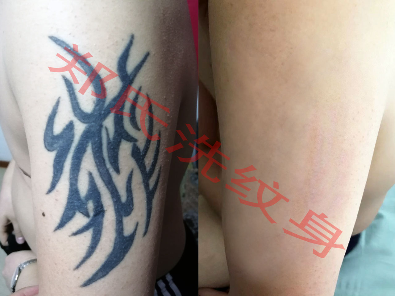 哈尔滨洗纹身