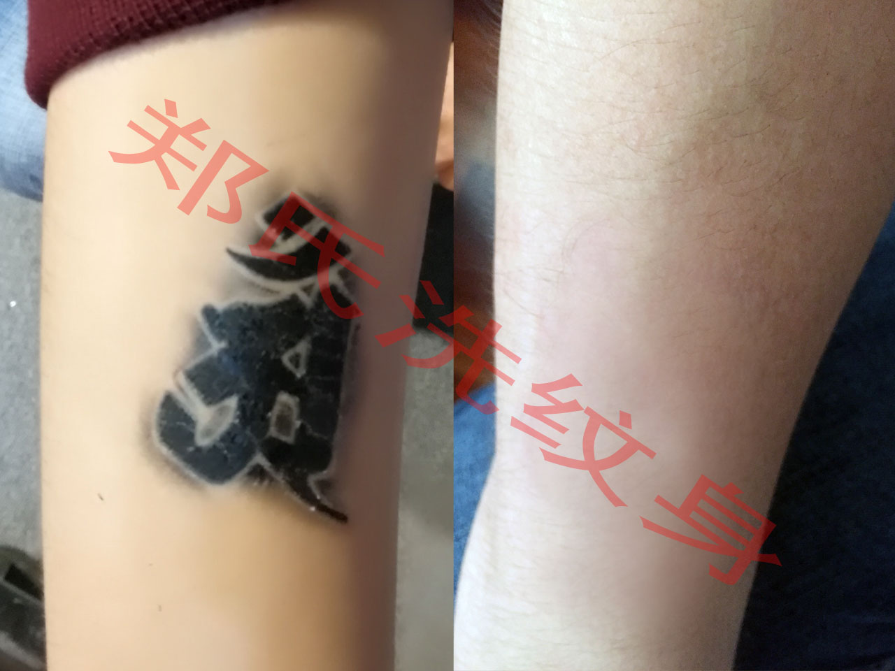 大连洗纹身