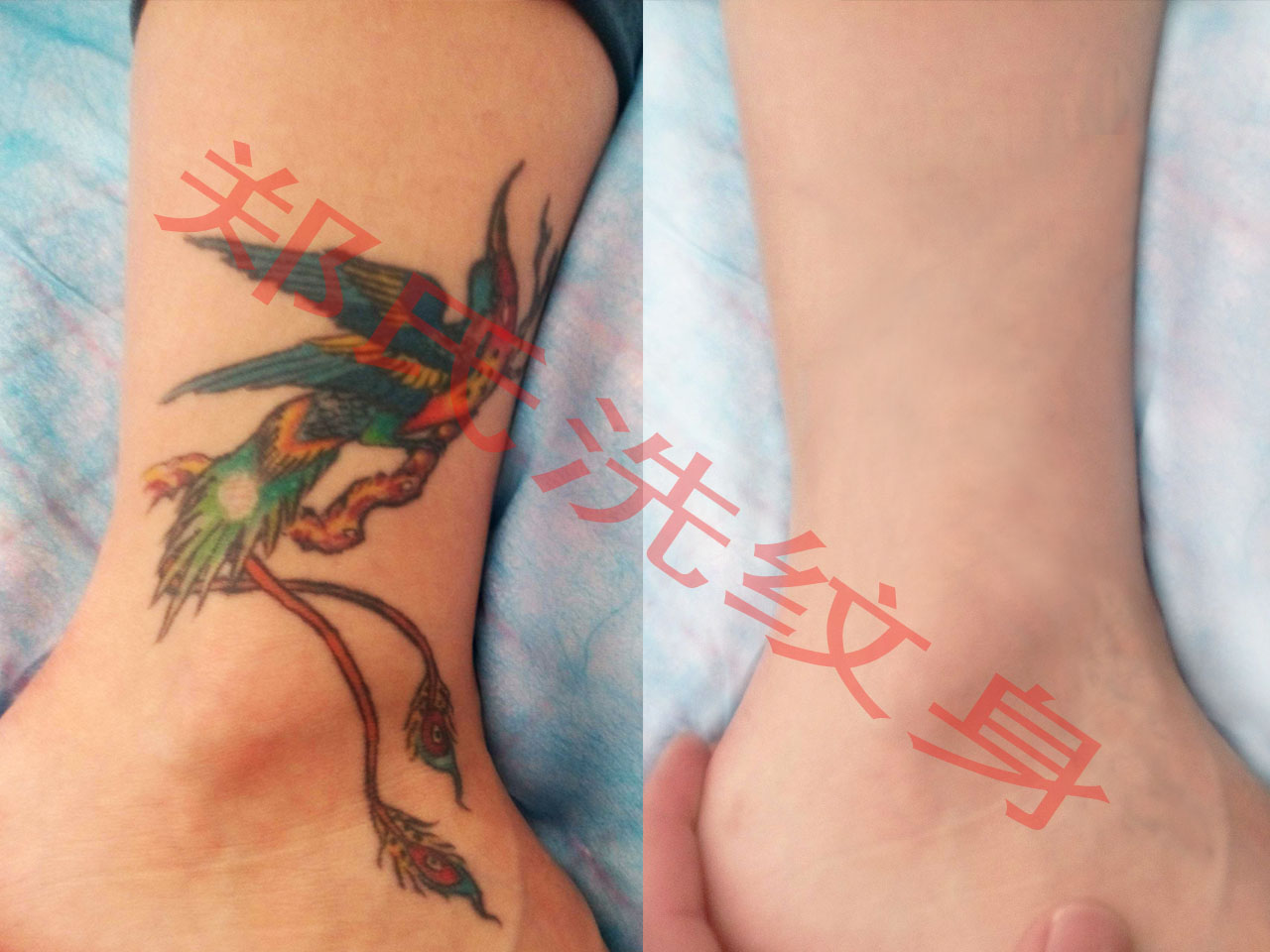 吉林洗纹身